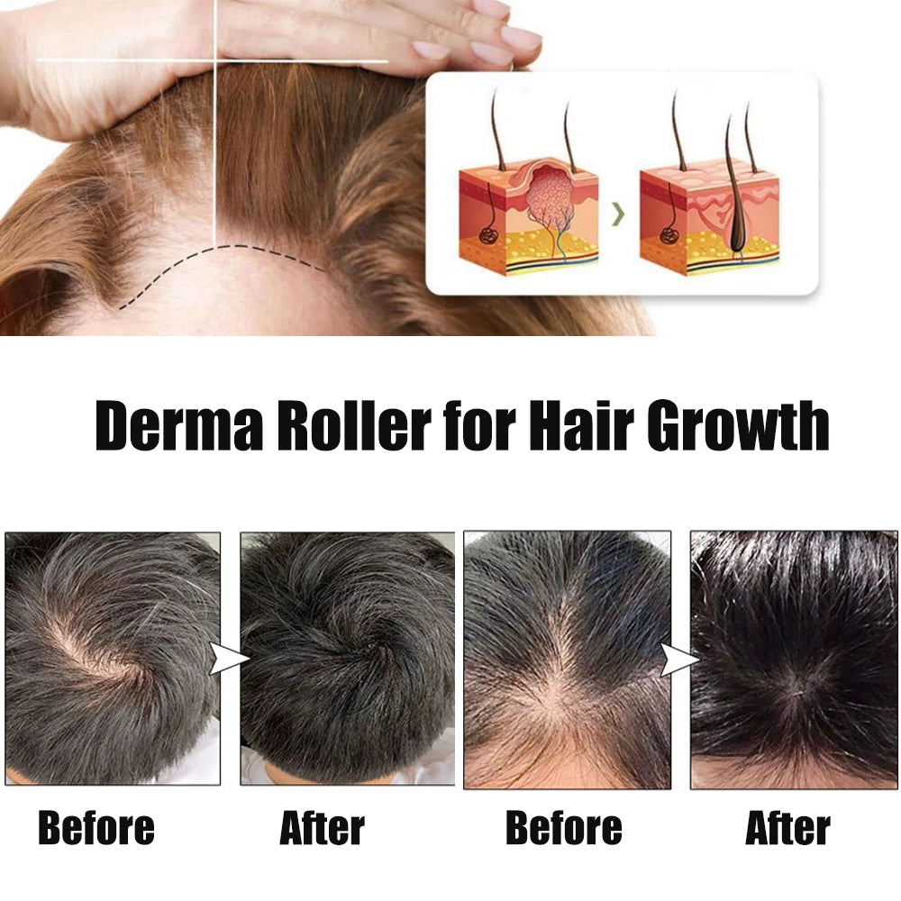 Professional 540 Derma Roller For Beard Hair Growth