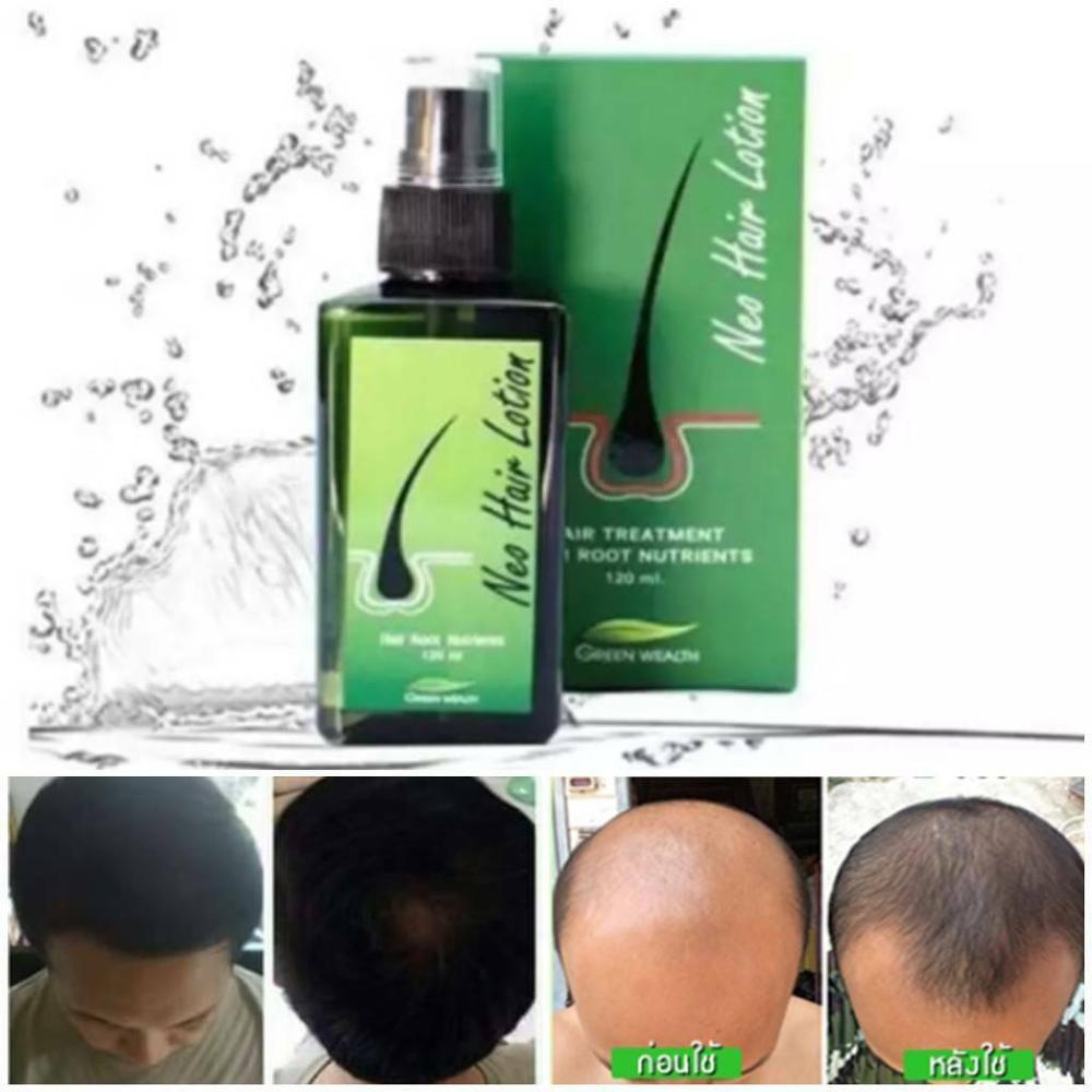 Neo Hair Lotion Growth Oil Herbs Treatment Original Products For Men and Women