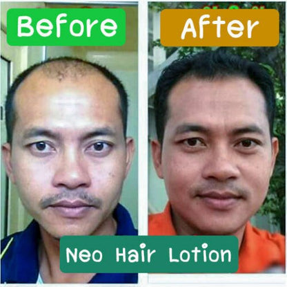 Best Seller Neo Hair Lotion Original Oil For Hair Growth Hair