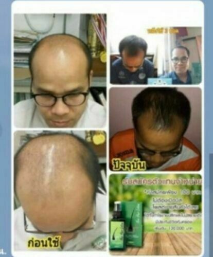 3 Pieces Neo Hair Lotion Paradise Thailand Hair and Beard Treatment