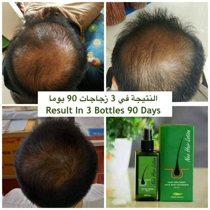 8x Neo Hair Lotion Growth Root Loss Treatments Beards