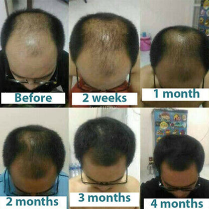 Treatment Original Thailand Hair Root Anti-Loss Beard